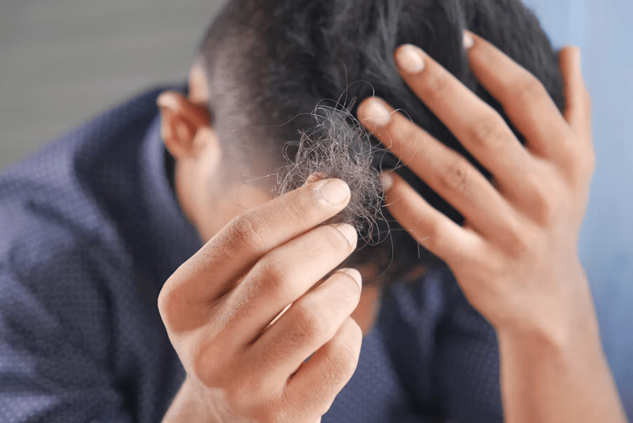 Haarausfall durch dauerhaften Biotin Mangel.