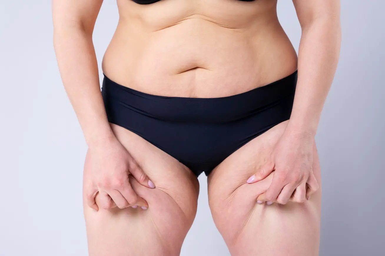 Abnehmen mit Lipödem: So purzeln die Pfunde - Tipps für einen Gewichtsverlust